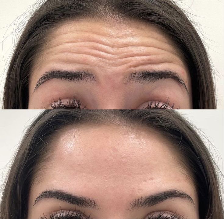 Botox