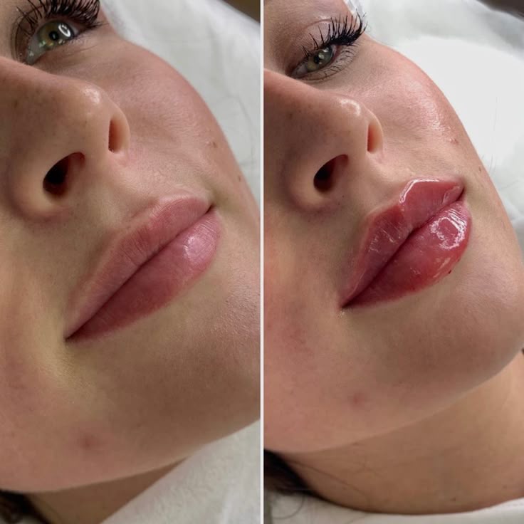 Preenchimento Labial