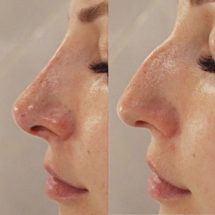 Perfiloplastia